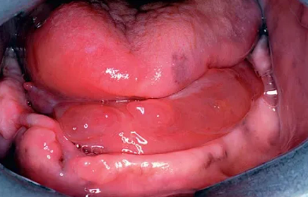 <p>commonly the <strong>first deep fascial space</strong> involved in mandibular odontogenic infections</p><ul><li><p><strong>boundaries:</strong></p><ul><li><p>floor of the mouth, submucosa, mylohyoid muscle</p></li></ul></li></ul><ul><li><p><strong>clinical findings:</strong></p><ul><li><p>elevation of the tongue</p></li><li><p>elevation of the floor of the mouth</p></li><li><p>difficulty with speech</p></li><li><p>difficulty swallowing</p></li><li><p>there should be <strong>no noticeable extraoral swelling</strong> because the infection is limited to an area <span style="color: red;">cephalad to the mylohyoid muscle</span>.</p></li></ul></li><li><p><strong>important feature:</strong></p><ul><li><p>isolated sublingual space infection <strong>without simultaneous submandibular involvement is unusual</strong>.</p></li><li><p>reason:</p><ul><li><p>sublingual space has <strong>no posterior boundary</strong></p></li><li><p>it freely communicates with the <strong>submandibular space</strong></p></li></ul></li></ul><p></p></li></ul><p></p>