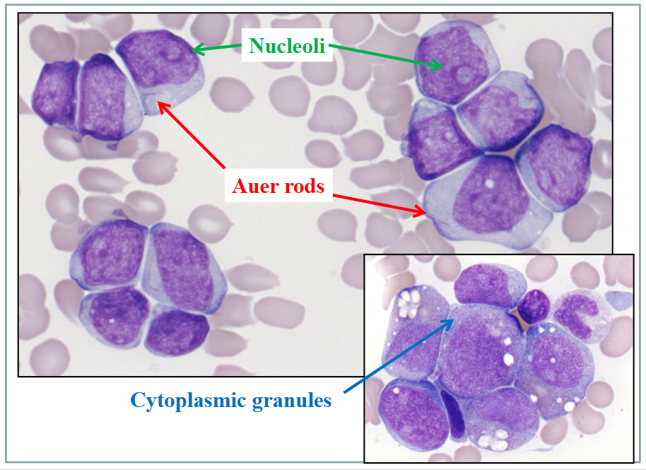 <p>Acute Myeloid Leukaemia</p>
