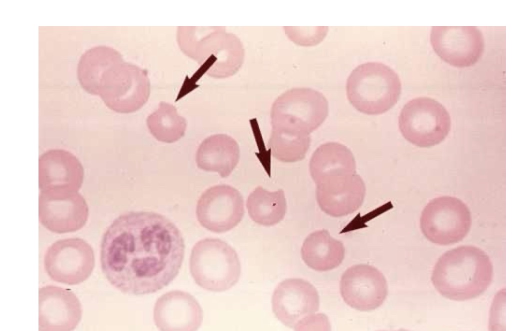 <p>What is G6PD deficiency</p>