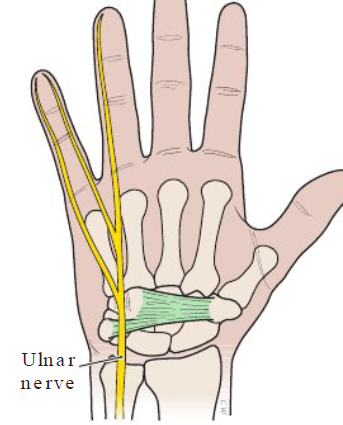 <p><strong>Definition</strong></p><ul><li><p>Lower arm and wrist compression of ulnar nerve</p></li></ul><p></p><p><strong>Causes</strong></p><ul><li><p>Bending hand (up, down, side to side) at wrist, holding pinkie finger away from hand</p></li></ul><p></p><p><strong>Symptoms</strong></p><ul><li><p>Numbness, tingle, loss strength in lower arm/ wrist</p></li></ul><p></p>