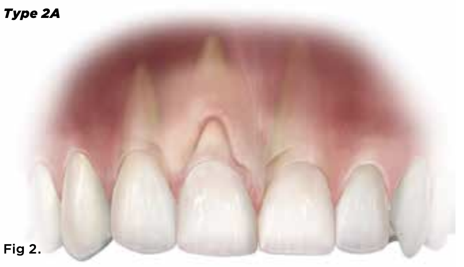 <p>Why can 2a tissue worsen problems with soft-tissue undercuts?</p>