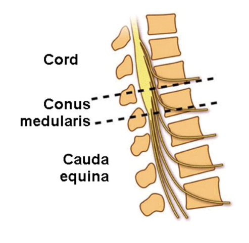 <p>Trauma that affects the spinal cord in the sacral area and lumbar nerve roots</p><p>Bladder bowel significantly impaired</p><p>Minimal lower extremity impairment</p><p>Sensory impairment are symmetrical in saddle area</p>