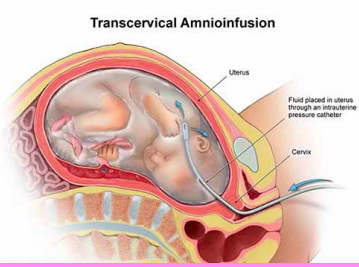 <p><strong>compression</strong> for umbilical cord</p><p><strong>reduction</strong> of <strong>variable decels </strong></p><p><strong>dilution</strong> of meconium stained amniotic fluid</p>