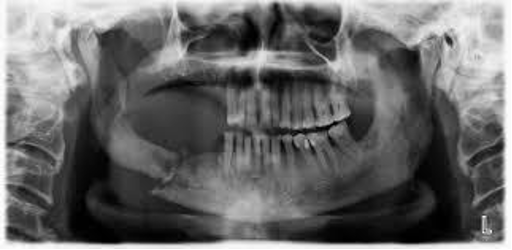 <p>CASE: A patient is scheduled for head-and-neck radiation and has several nonrestorable, periodontally involved teeth. What dental principle best reduces future ORN risk, and why is the mandible particularly important?</p>