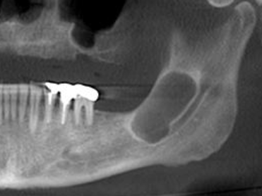 <p>Radiographic Borders: borders that are defined and in which one can clearly see the exact margins and extent of pathology </p>