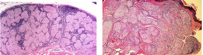 <ul><li><p>Dense infiltrates of<span style="color: red;"> inflammatory cells in dermis</span></p></li><li><p><strong>Macrophages and lymphocytes</strong> (sometimes eosinophils and neutrophils) compose nodules</p></li></ul><p></p>