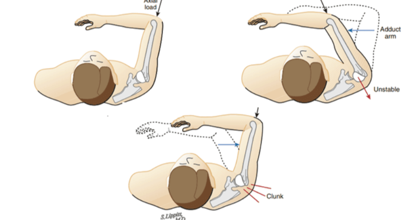 <p>Lift the arm to shoulder height in front of you. Move it across your body, then push it inward. A sudden jump, click, or pain is positive.</p>