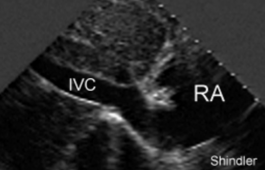 <ul><li><p>a membranous, endocardial tissue flap</p></li><li><p>located at <span style="color: rgb(0, 139, 255);">opening of the IVC</span> into <span style="color: rgb(0, 154, 255);">RA</span></p><ul><li><p>may produce flow obstruction</p><ul><li><p><u>IVC</u> may become <strong>dilated</strong></p></li></ul></li></ul></li><li><p>needs to be determined from pathological mass / tumor</p></li></ul><p></p>