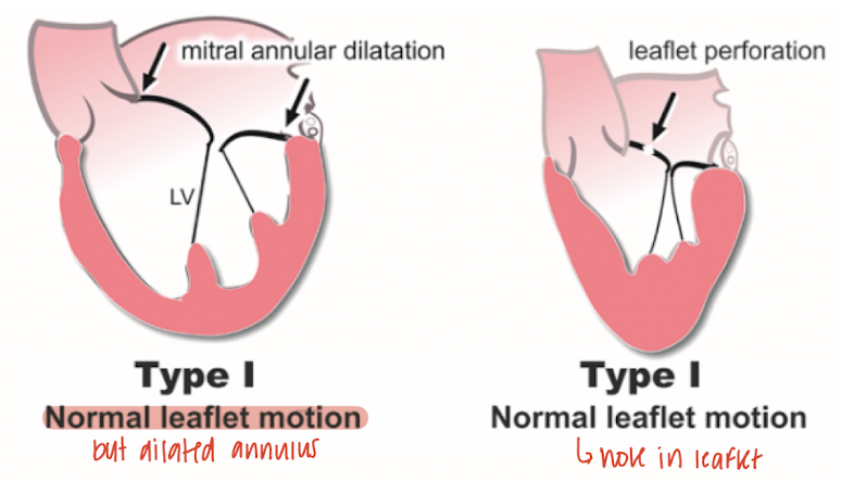 <ul><li><p><strong>MR occurs</strong> despite normal leaflet motion </p></li><li><p><u>cause</u>: <strong>annular dilatation</strong> (dilated CM) or <strong>leaflet perforation </strong>(sequelae of endocarditis) </p></li></ul><ul><li><p>MR jet is <strong>central</strong></p></li></ul><p></p>