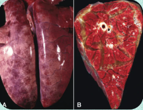 <p>PULMONARY EDEMA</p><p>According to the text panel on the right, what physical structural change happens to the borders of the lung lobes when they are distended by edema fluid?</p>