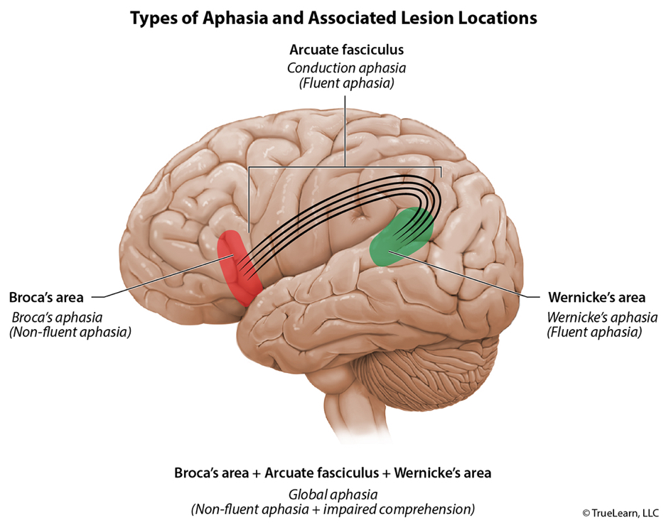 <p>-arcuate fasciculus; inability to repeat simple phrases</p>