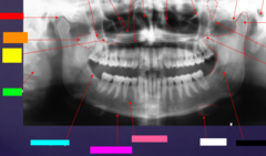 <p>ID the hard tissue anatomy indicated by the arrow pointing from the white box:</p>