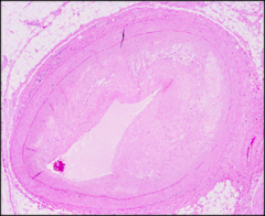 <p>identify the pathology within the lumen of the artery:</p>