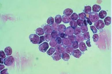 <p><strong><u>Predominant Cells in CSF</u></strong></p><ul><li><p>found in <span style="color: red;">acute leukemia</span></p></li><li><p>either in lymphoblast, myeloblast, or monoblast form</p></li></ul><p></p>
