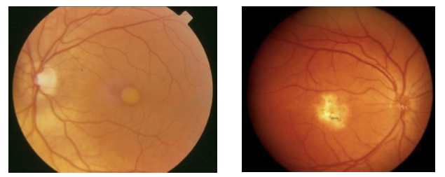 <p>Initial pigment disturbances appear around ages 5–10.<br>The lesion evolves into the classic “egg‑yolk” (vitelliform) appearance in the macula.</p>