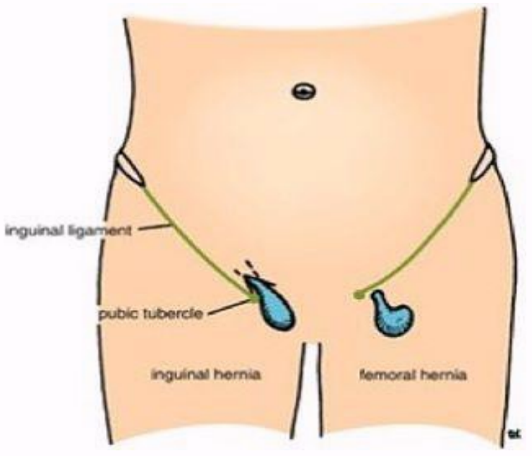 <ul><li><p>Ventral</p><ul><li><p>Anterior and lateral abdominal wall</p></li><li><p>Types: umbilical, paraumbilical, epigastric, hypogastric, and incisional (subtype is parastomal)</p></li></ul></li><li><p>Groin</p><ul><li><p>Ilioinguinal crease and adjacent areas</p></li><li><p>Types: indirect inguinal, direct inguinal, femoral, and Spigelian</p></li></ul></li></ul><p></p>