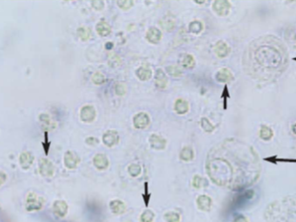 <ul><li><p>small and round</p></li><li><p>presence indicates bleeding somewhere in the urinary tract but 2-3 per hpf is normal</p></li></ul><p></p>