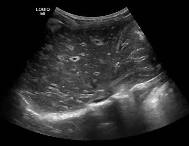 <p>normal-hypo liver parenchyma, prominent portal veins, hepatomegaly, splenomegaly </p>