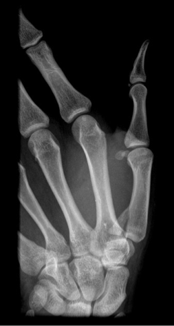 <p>What type of fracture is shown in the image?</p>