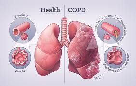 <p><span style="background-color: transparent;">Chronic Obstructive Pulmonary Disease (COPD)</span></p>