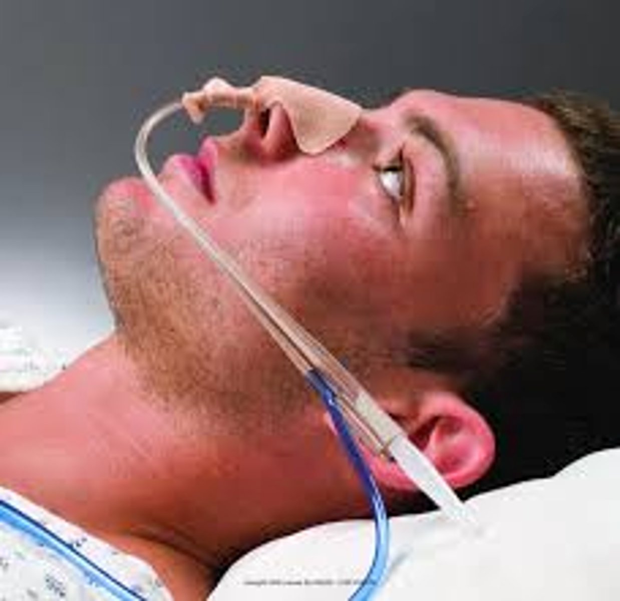 <p>feeding tube inserted through the nose into the stomach</p>