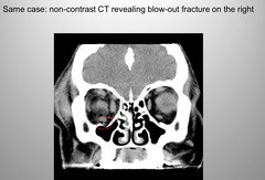 <p>Orbital Blow out fracture</p>