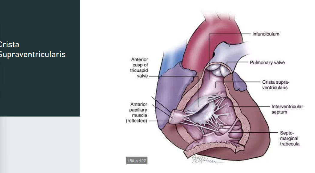 <p>Description: prominent muscular ridge formed by the parietal muscle band and the infundibular septum</p><p>Shape: arch shaped</p><p>*2 other muscle bands are found in the RV</p><p></p><p><span>parietal" refers to the part of this muscular ridge that extends along the </span><strong>parietal wall (free wall)</strong><span> of the right ventricle, specifically between the tricuspid and pulmonary valves</span></p>