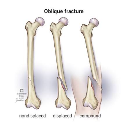 <p>Non displaced fracture:</p>