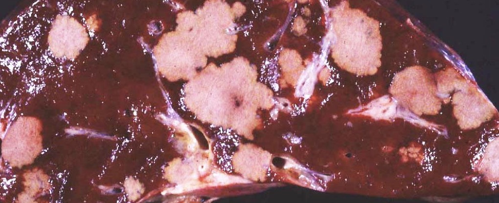 <p>Dx + pathogenesis in this liver from a feedlot steer</p>