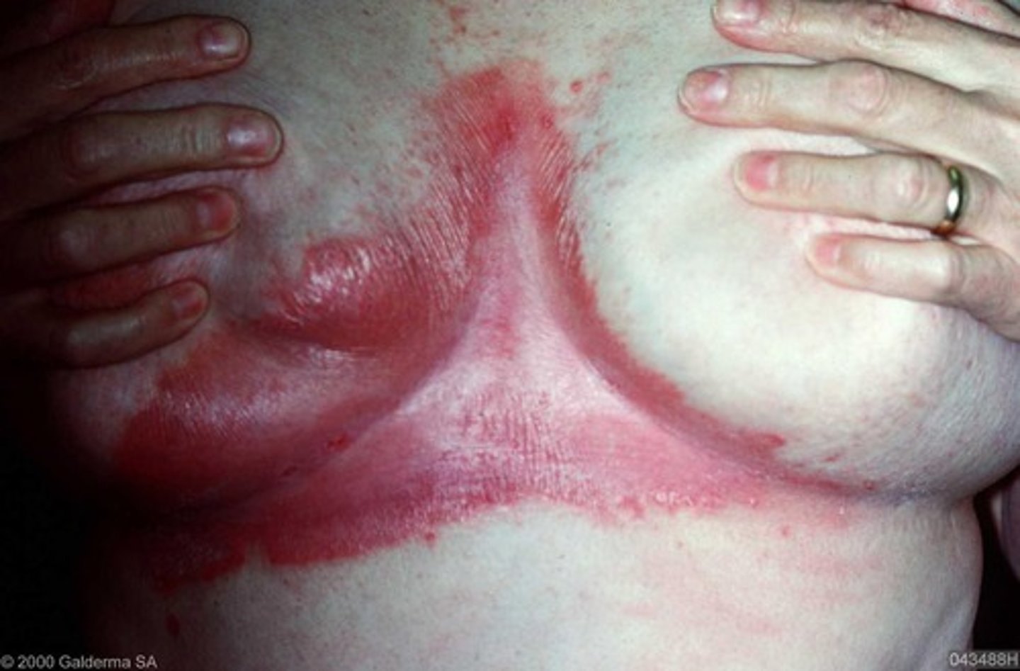 <p>erythematous patches in intertiginous areas (skin folds) without scale</p><p>systemic tx if patient desires</p>