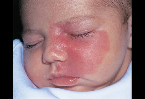 <p>Large, flat, hemangioma on the scalp or face, usually along CN V, dark red/purple color, consists of mature capillaries, present at birth (nevus flammeus)</p>