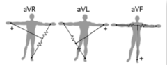 <p>pieraksta elektriskās aktivitātes starpību starp aktīvo un pasīvajiem elektrodiem</p><p>➢ Aktīvs elektrods atrodas uz ekstremitātes</p><p>➢ Pasīvs elektrods apvienots no diviem pārējiem elektrodiem</p>