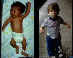 <p>Microcephaly, smooth philtrum, thin upper lip, ADHD-like behavior. Most common cause of mental retardation.</p>