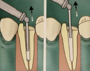 <p>T/F: It is recommended to slowly move the endodontic tip upward while injecting cement</p>