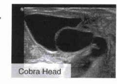 <p>Dilatation of the distal ureter which may be seen in patients with ureteroceles.</p>