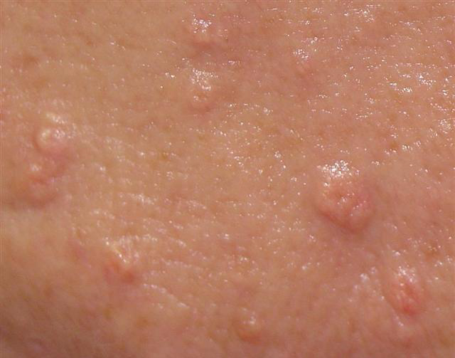 <p>Small yellowish or skin-colored bumps, often with a central depression.</p>