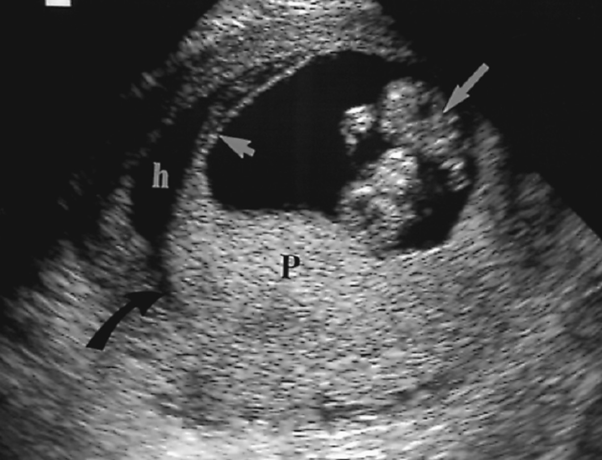 <p>What pathology is seen in this image?</p>