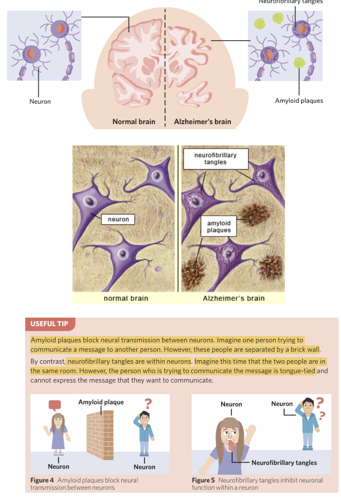 <ul><li><p class="Paragraph SCXO112878965 BCX0" style="text-align: left;"><span style="background-color: inherit; line-height: 20.7px; color: windowtext;"><strong>Amyloid plaques </strong>form outside a neuron and between neurons – where they are fragments of the protein beta-amyloid that accumulate into insoluble plaques that interfere with and inhibit communication between neurons</span><span style="line-height: 20.7px; color: windowtext;"> </span></p></li></ul><p class="Paragraph SCXO112878965 BCX0" style="text-align: left;"><span style="background-color: inherit; line-height: 20.7px; color: windowtext;">--> You can think of it as 'a'myloid plaques – 'a'round neurons</span><span style="line-height: 20.7px; color: windowtext;"> </span></p><p class="Paragraph SCXO112878965 BCX0" style="text-align: left;"><span style="line-height: 20.7px; color: windowtext;"> </span></p><ul><li><p class="Paragraph SCXO112878965 BCX0" style="text-align: left;"><span style="background-color: inherit; line-height: 20.7px; color: windowtext;"><strong>Neurofibrillary tangles </strong>that form inside a neuron (inside cell body) - which are an accumulation of the protein tau that forms insoluble tangles within neurons, which then inhibit/reduce the transportation of substances throughout the neuron and eventually kill the neuron </span><span style="line-height: 20.7px; color: windowtext;"> </span></p></li></ul><p></p>