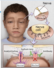 <p>- Antibodies block postsynaptic Ach receptors → impairs ability of muscle to respond and release Ca2+ → muscle weakness</p>