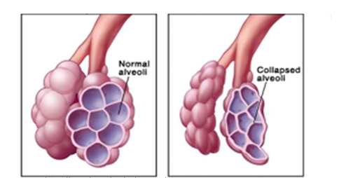 lack of surfactant in premature infants, increased alveolar surface tension, increased risk of alveolar collapse