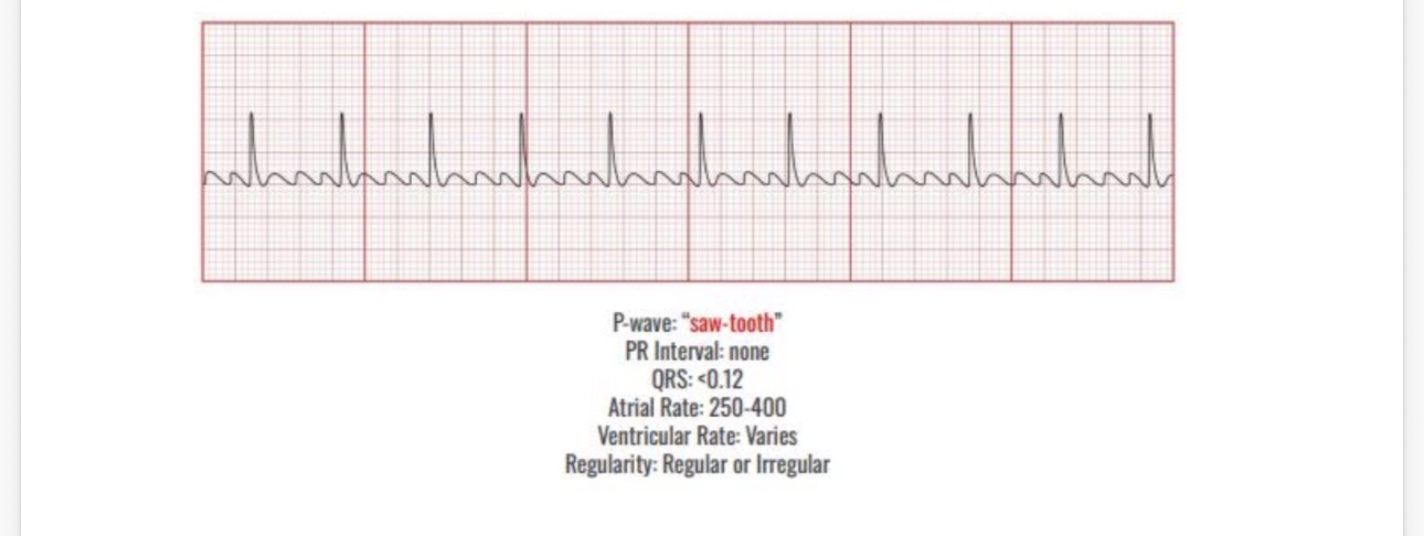 <p>Causes</p><p>Heart disease</p><p>Mi</p><p>CHF</p><p>pericarditis </p><p></p><p>Interventions </p><p>Cardioversion</p><p>Pacing</p><p>Antiarrhythmics -amiodarone</p><p>Beta blocker metoprolol </p><p>Calcium channel blockers diltiazem</p>