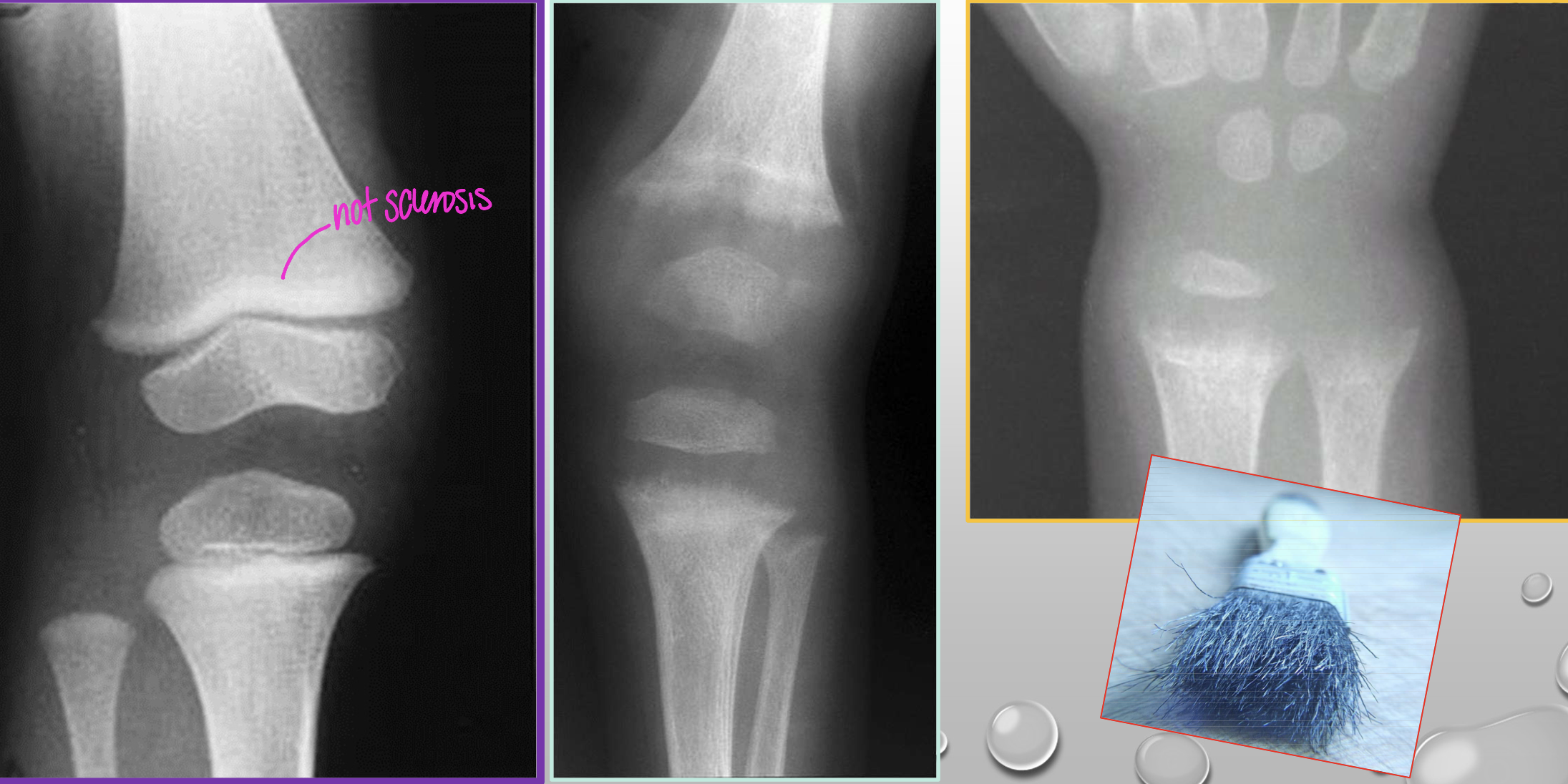 <p>What radiographic finding is in this image of Rickets</p>