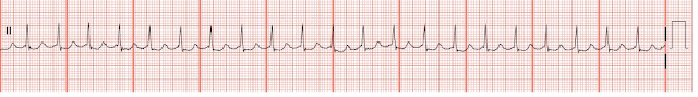 <p>Rate: >100-200</p><p>Regularity: regular </p><p>P waves are either absent, in QRS, after QRS, or inverted before QRS</p>