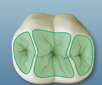 <p>Shallow depression in tooth</p>