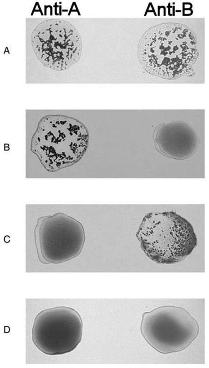 <p>If a patient with type B blood receives AB blood, the patient's anti-A antibodies will agglutinate with the A antigens in the donor blood.</p>