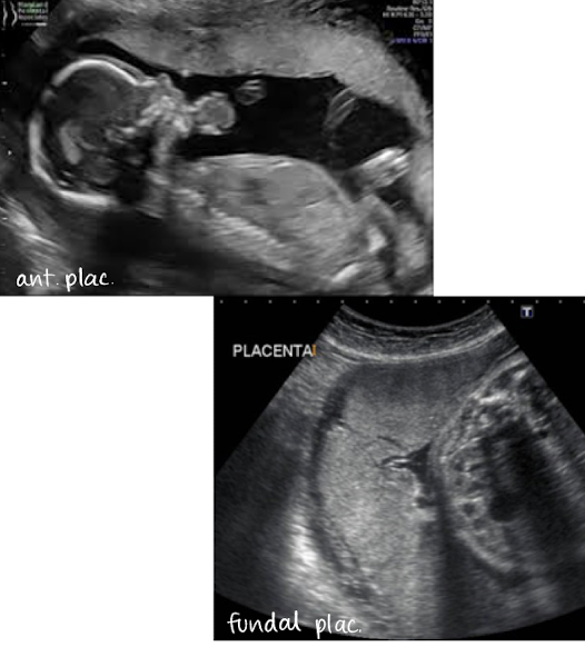 <ul><li><p>refers to when <span style="color: red;">placenta changes position in uterine cavity</span></p></li><li><p>primarily explained by 2 theories: </p><ul><li><p><span style="color: yellow;">LUS growth theory</span> (when expanding uterus pulls placenta upward)</p></li><li><p>trophotropism theory (<span style="color: yellow;">atrophic placenta in areas of low blood supply</span>)</p></li></ul></li></ul><ul><li><p>location of placenta can be identified in 1st trimester</p></li></ul><p></p>