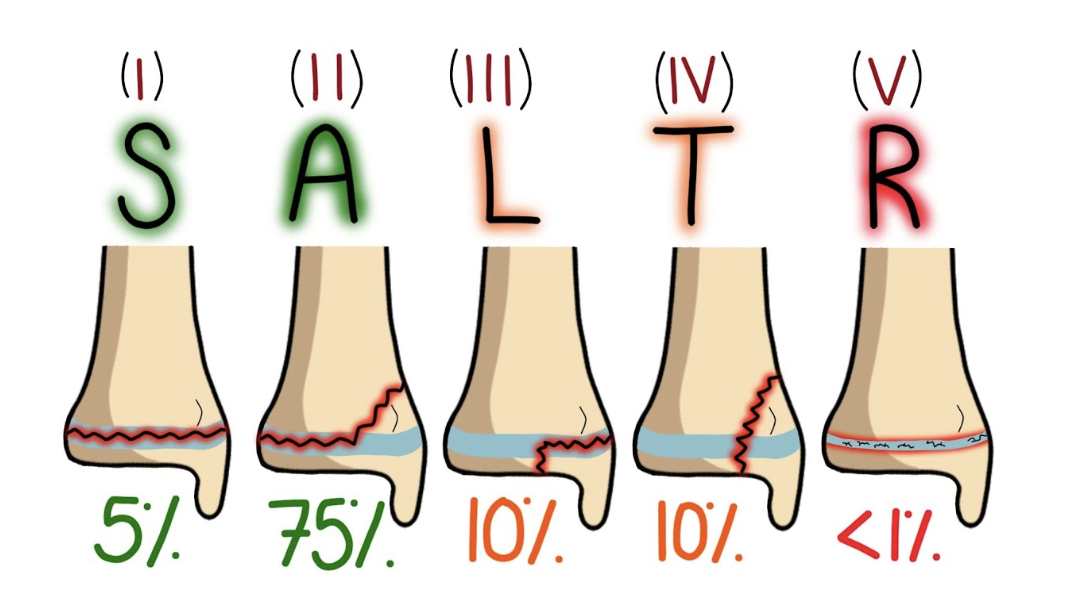 <ul><li><p><strong>S (Straight across):</strong> Type I – Dwars door de groeischijf.</p></li><li><p><strong>A (Above):</strong> Type II – Door de groeischijf en de metafyse (erboven).</p></li><li><p><strong>L (Lower):</strong> Type III – Door de groeischijf en de epifyse (eronder).</p></li><li><p><strong>T (Through/Two):</strong> Type IV – Verticaal door zowel metafyse, groeischijf als epifyse.</p></li><li><p><strong>R (ERasure/Ram):</strong> Type V – Compressie/verbrijzeling van de groeischijf.</p></li></ul><p></p>