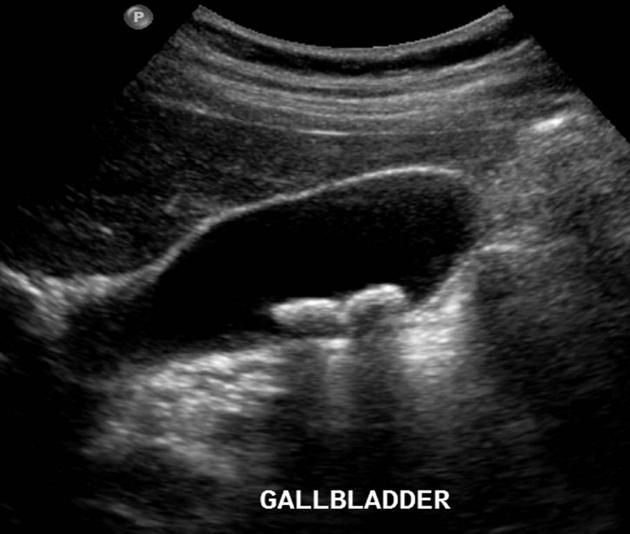 <p>What is the pathology and its risk factors?</p>