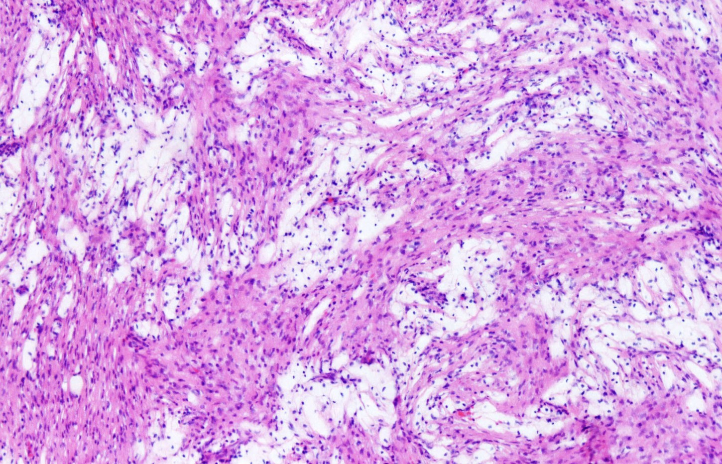 <p>Tumeur métaphysaire tibia enfant</p><p>diagnostic</p><p>définition</p><p>age</p><p>topographie</p><p>anatomie</p><p>histologie</p><p>moléculaire</p><p>syndrome </p>