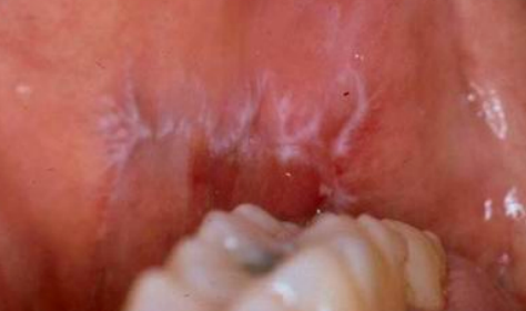 <p><strong>ex: </strong>striae of wickham</p><p>type of papules that has lacework of intersecting white lines</p>